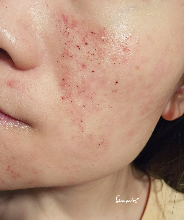 【台北蜂巢皮秒心得】愛爾麗診所 全臉探索皮秒雷射(蜂巢) 