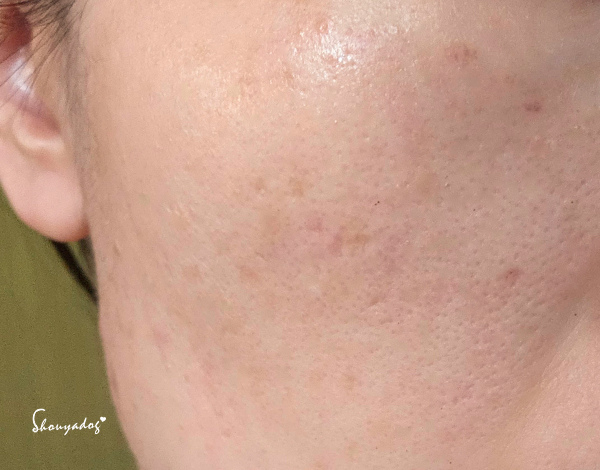 【台北蜂巢皮秒心得】愛爾麗診所 全臉探索皮秒雷射(蜂巢) 