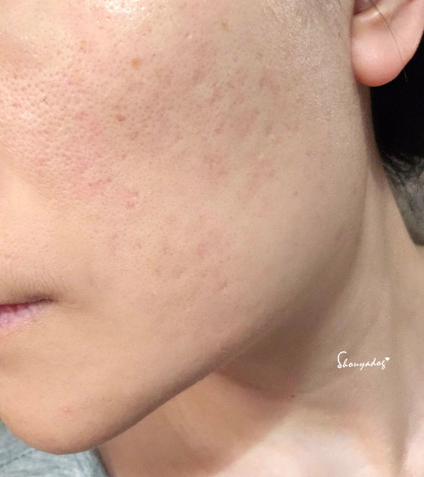 【台北蜂巢皮秒心得】愛爾麗診所 全臉探索皮秒雷射(蜂巢) 