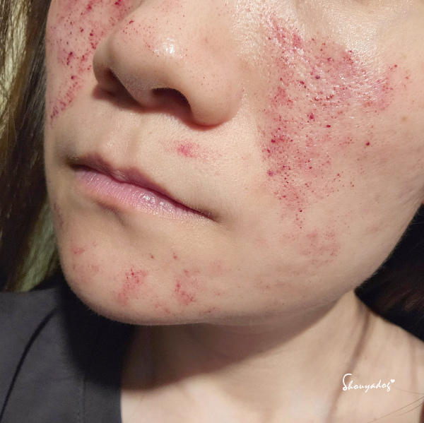 【台北蜂巢皮秒心得】愛爾麗診所 全臉探索皮秒雷射(蜂巢) 