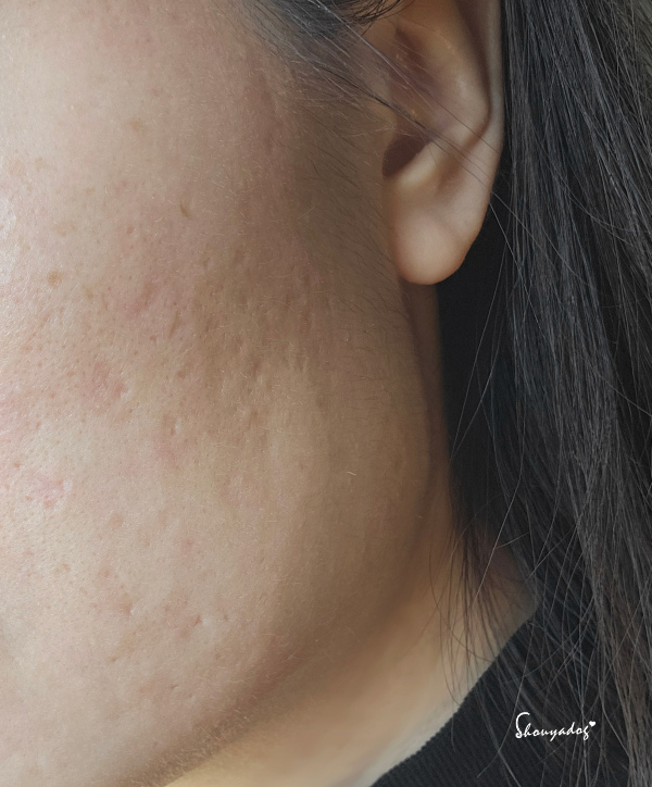 【台北蜂巢皮秒心得】愛爾麗診所 全臉探索皮秒雷射(蜂巢) 