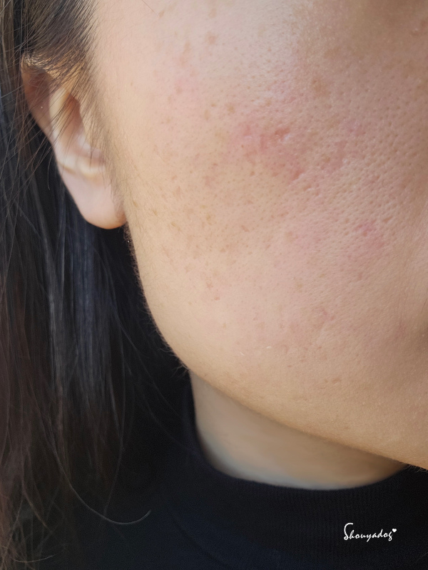 【台北蜂巢皮秒心得】愛爾麗診所 全臉探索皮秒雷射(蜂巢) 