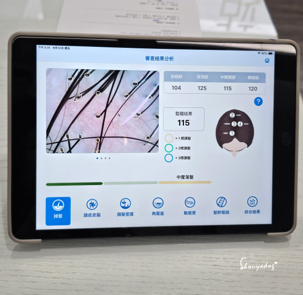 愛爾麗診所頭皮拉髮密雷射 台北拉髮密雷射心得 養髮醫美體驗分