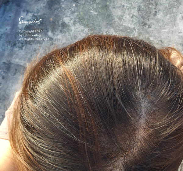 愛爾麗診所頭皮拉髮密雷射 台北拉髮密雷射心得 養髮醫美體驗分