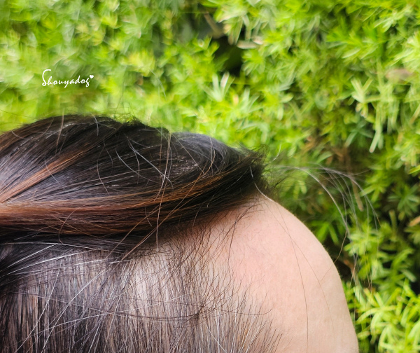 愛爾麗診所頭皮拉髮密雷射 台北拉髮密雷射心得 養髮醫美體驗分