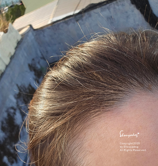 愛爾麗診所頭皮拉髮密雷射 台北拉髮密雷射心得 養髮醫美體驗分