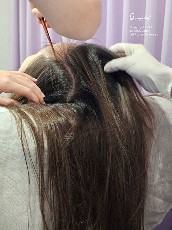 愛爾麗診所頭皮拉髮密雷射 台北拉髮密雷射心得 養髮醫美體驗分