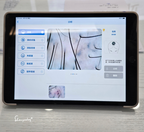 愛爾麗診所頭皮拉髮密雷射 台北拉髮密雷射心得 養髮醫美體驗分