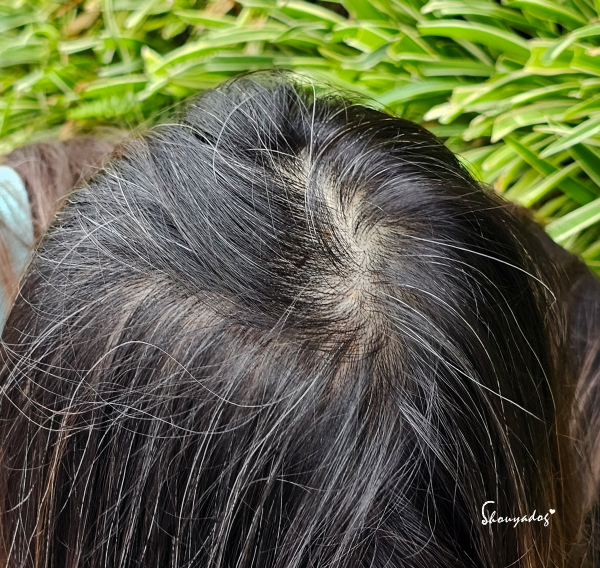 愛爾麗診所頭皮拉髮密雷射 台北拉髮密雷射心得 養髮醫美體驗分